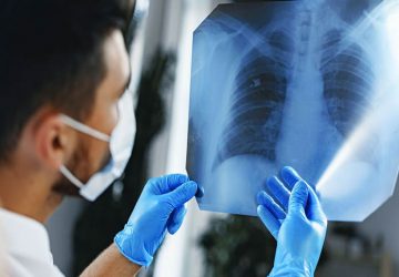 Step by step instructions to Lessen Your Gamble of Creating Cellular breakdown in the lungs